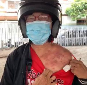 Mengaku Kena Semprot Disinfektan, Ternyata Perempuan Ini Mengidap Penyakit Herpes