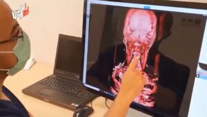 Profesor ITS Kembangkan Sistem Stereotaktik untuk Dukung Bedah Saraf Otak